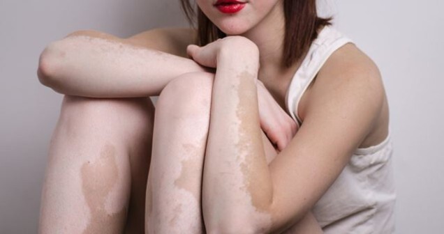 Kuran’da Vitiligo Tedavisi: İslami Yaklaşım ve Dualar
